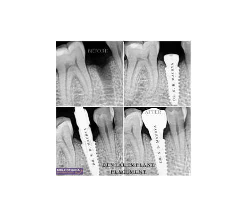 Restoring Function After RCT Failure: A Case of Dental Implant Rehabilitation