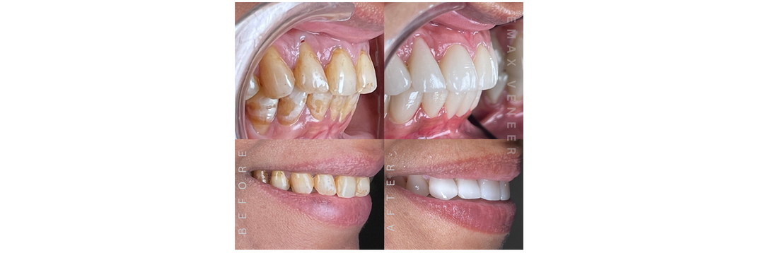 Case Of Porcelain Veneer ; Smile Transformation Story: A Journey to a Confident Smile