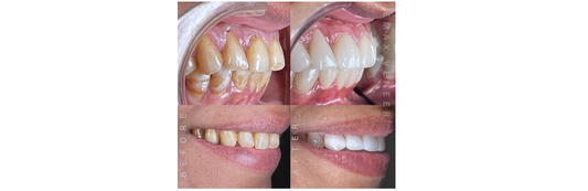 Case Of Porcelain Veneer ; Smile Transformation Story: A Journey to a Confident Smile