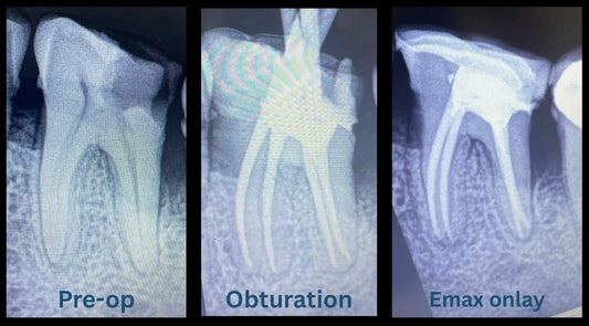 No Extraction Needed: How We Saved a Lower Molar with Root Canal & E-max Onlay