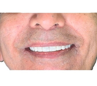 Case Of Full Mouth Rehabilitation; Rebuilding Confidence: A Smile Journey