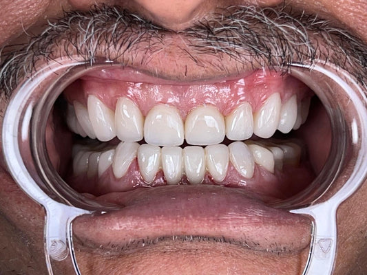 Restoring Function and Aesthetics: Full Mouth Rehabilitation in a Patient with Deep Bite and Generalized Tooth Wear