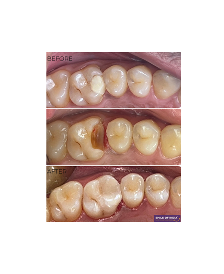 Conservative Endodontic Approach: A Case of Vital Pulp Therapy