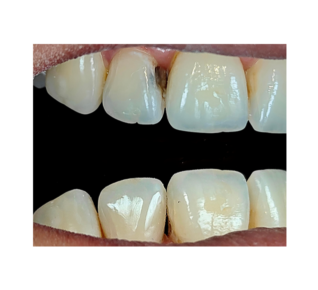 Smile Precision: Direct Composite for Lateral Incisor Repair